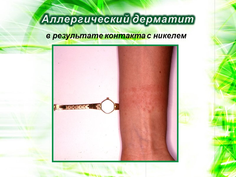 Аллергический дерматит в результате контакта с никелем